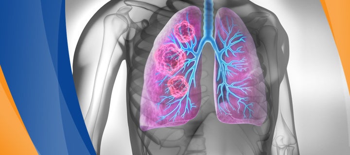 Imaging of lung cancer at I-MED Radiology | I-MED Radiology Network