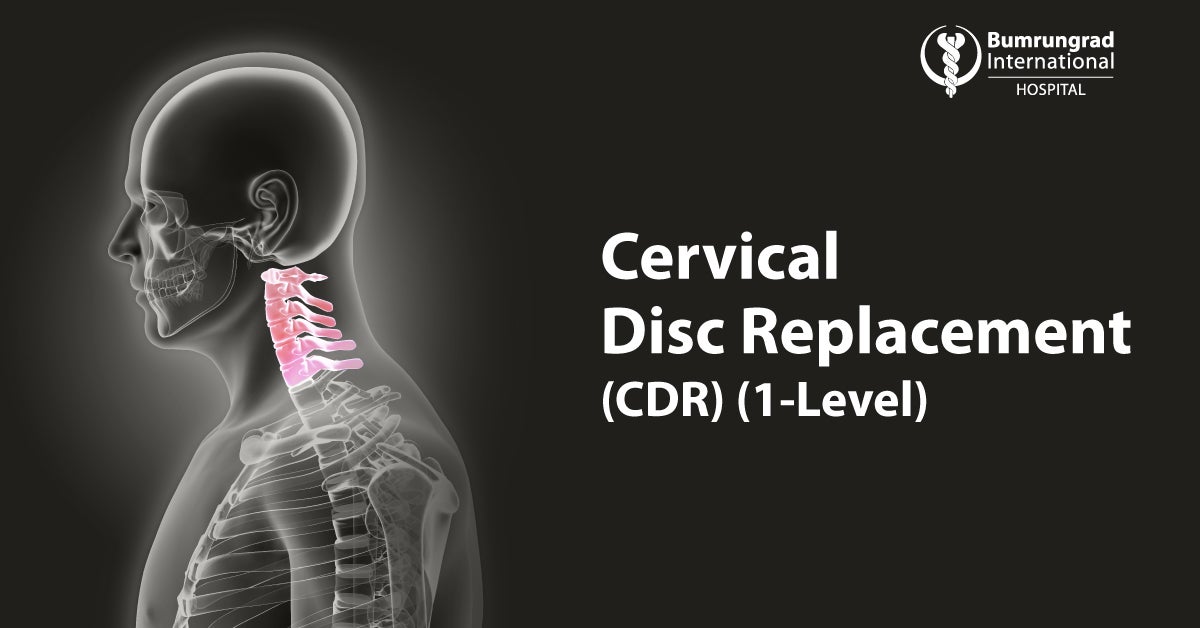 Cervical Disc Replacement CDR   8469e739 430b 4972 A669 8c39afa7428e 