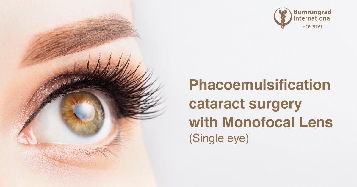 Phacoemulsification Single Eye with Monofocal Lens for ...