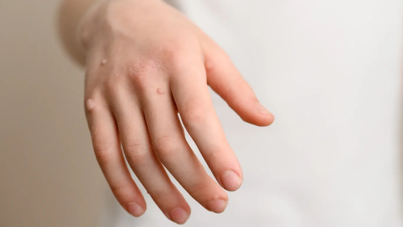 Tretinoin cream for the treatment of warts?