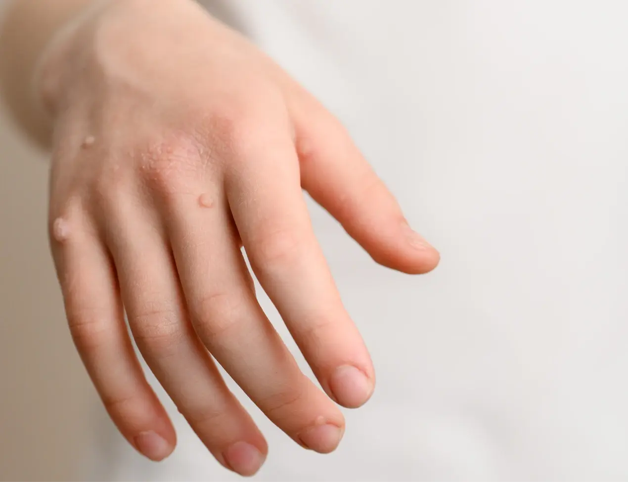 Tretinoin cream for the treatment of warts?