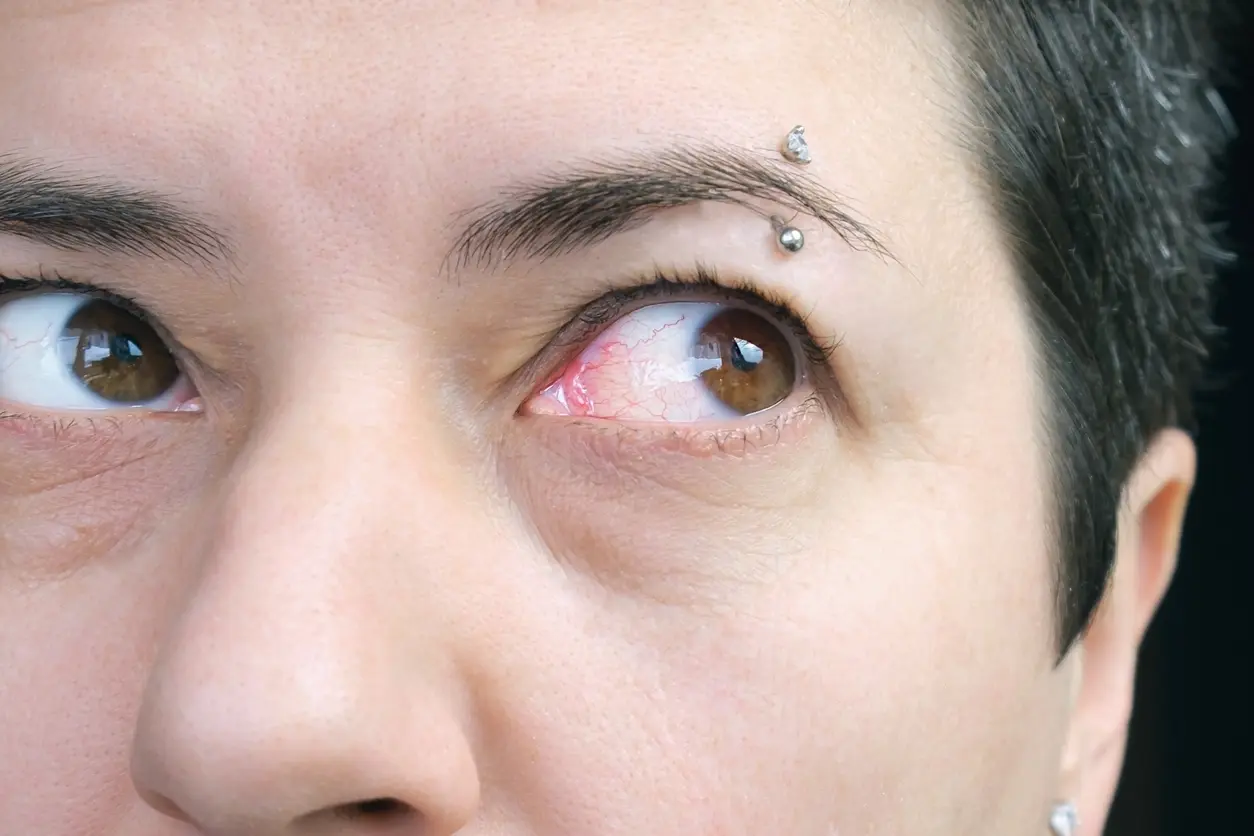 Red Veins in Your Eyes