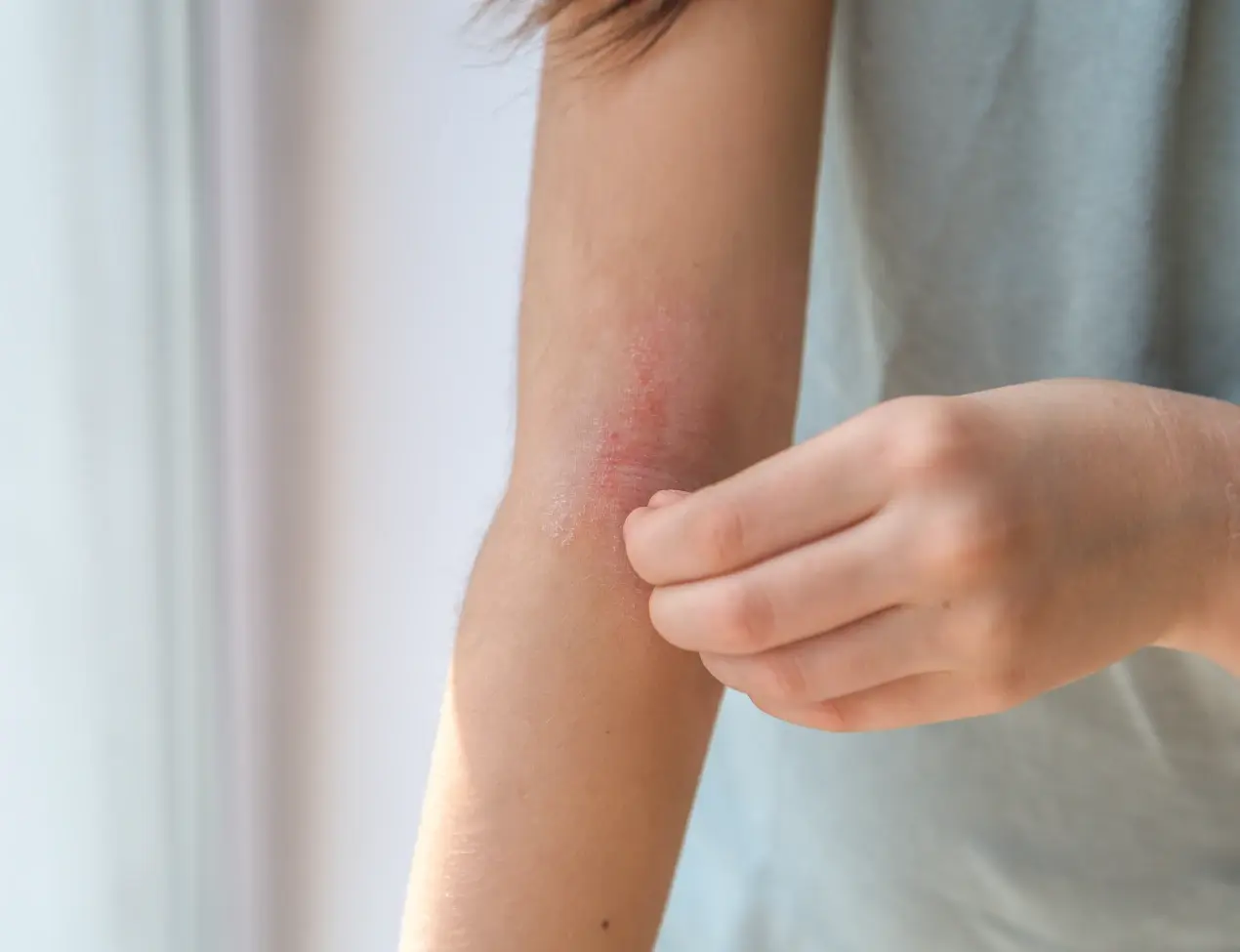 Eczema and food allergies: Leaky Gut Syndrome