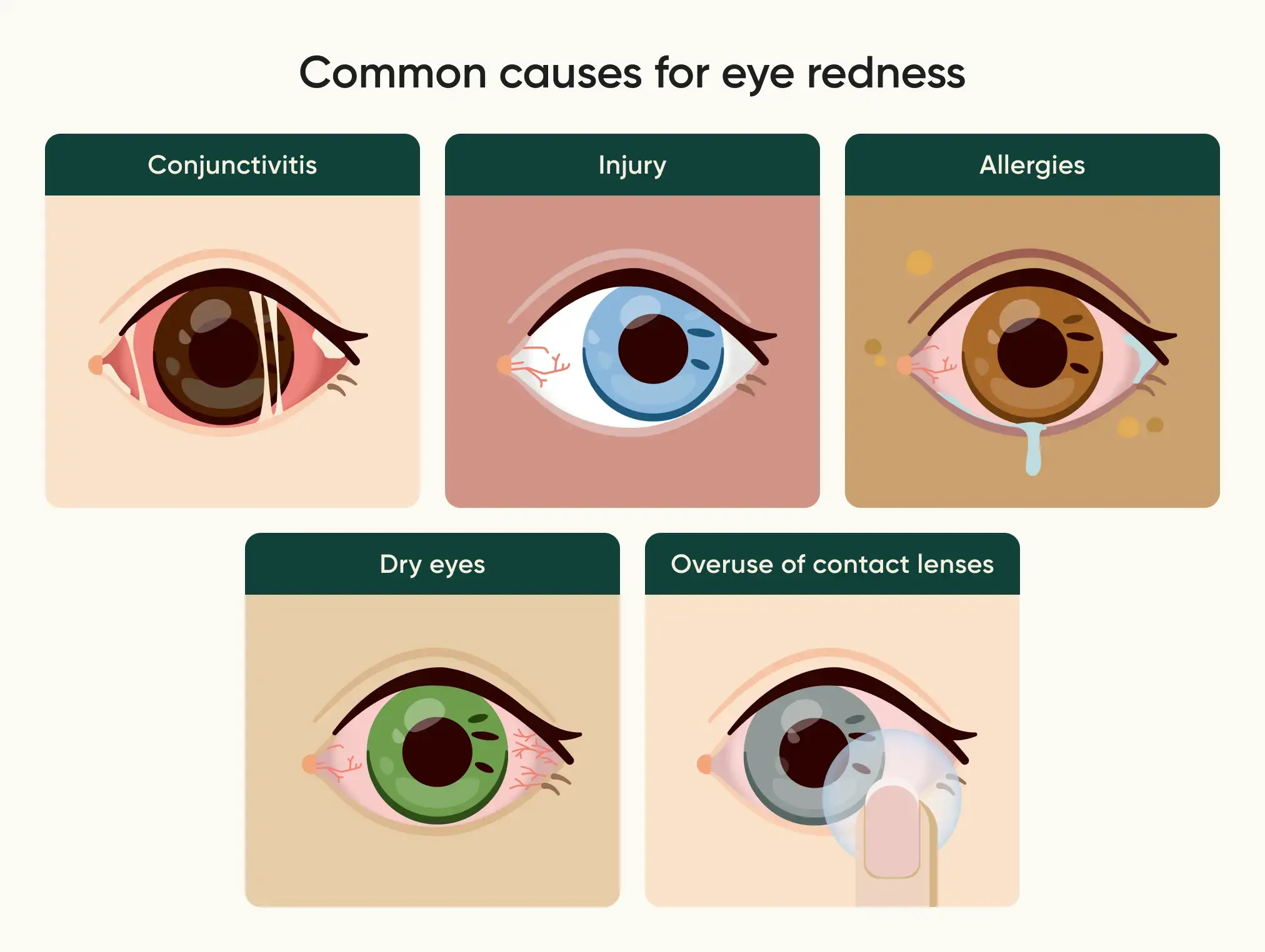 Common causes of eye redness and what they look like