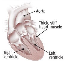 Image of diastolic heart failure. 