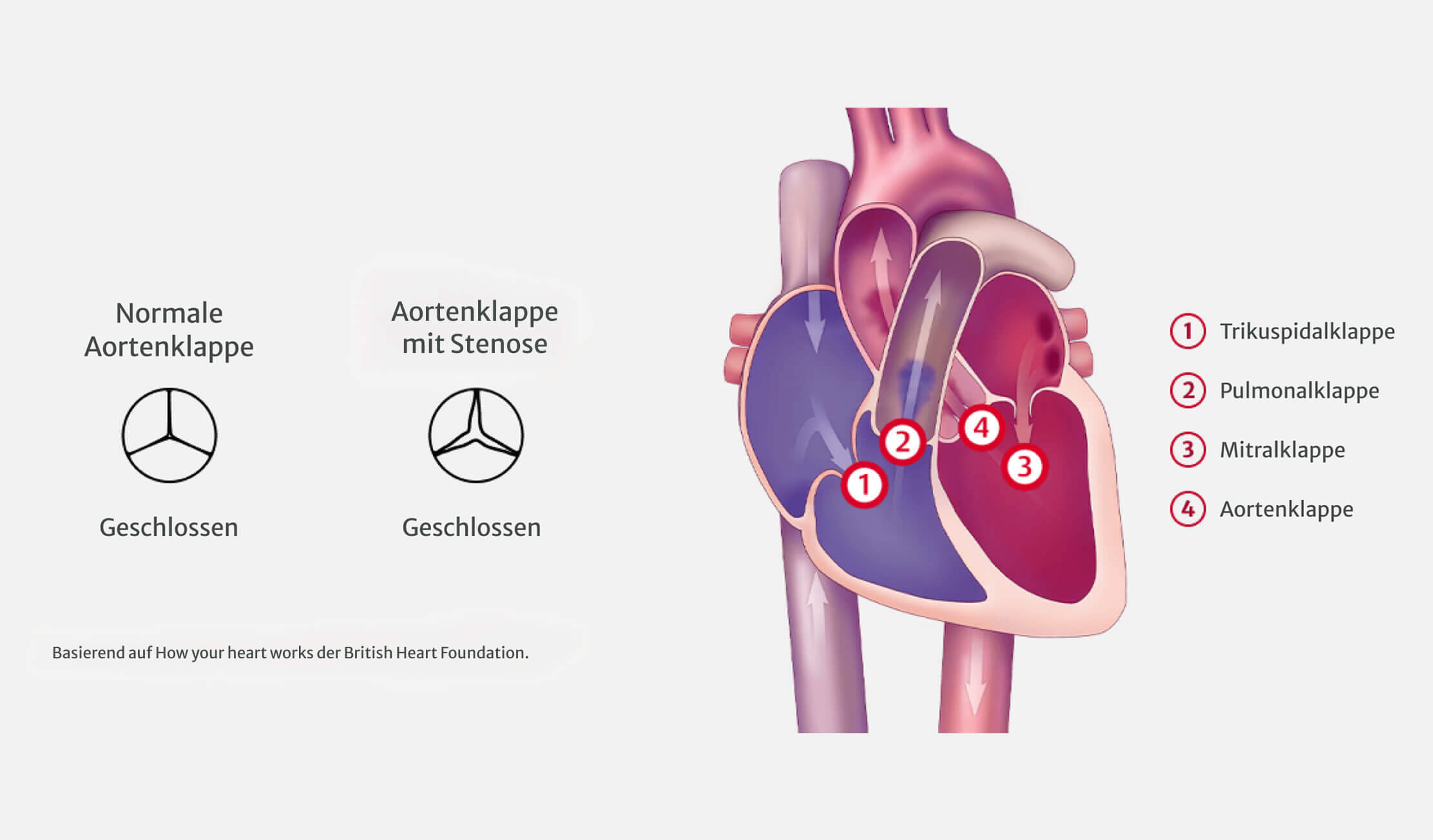 normal aortic valve vs aortic valve stenosis
