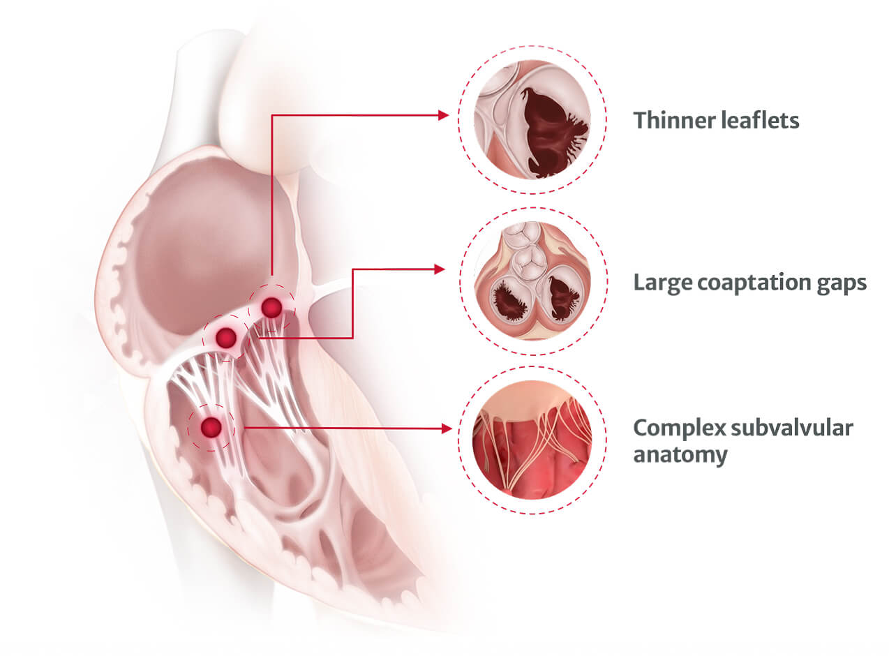 tricuspid valve