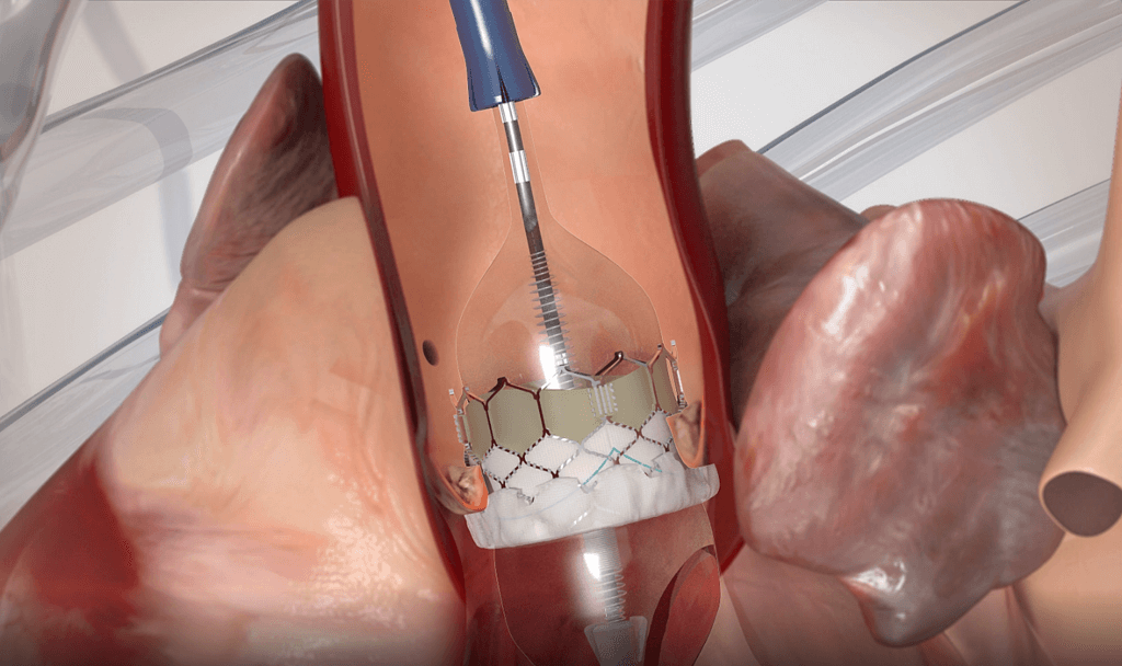 SAPIEN 3 - transfemoral procedure animation