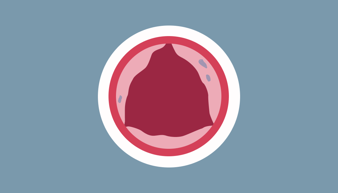 mild aortic stenosis