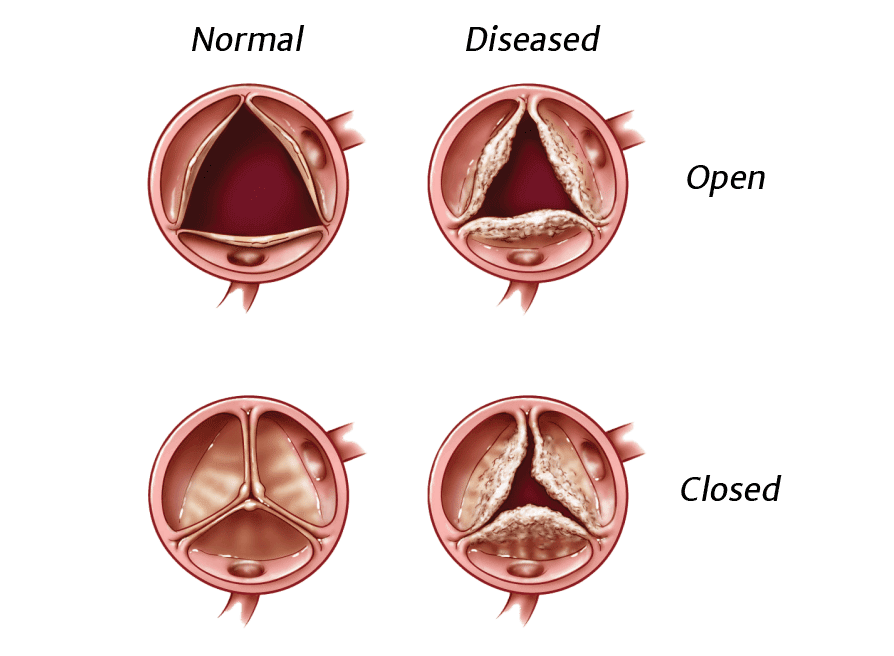 heart-valve-disease-information-edwards-lifesciences