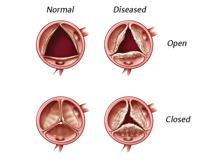 transcatheter-heart-valves-edwards-lifesciences
