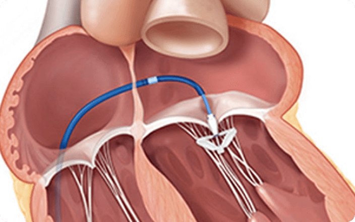 Teer Issue What is transcatheter edge-to-edge repair (TEER) | Edwards Lifesciences