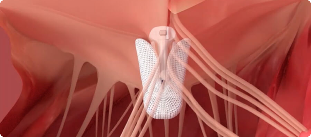 The PASCAL Precision system | Edwards Lifesciences