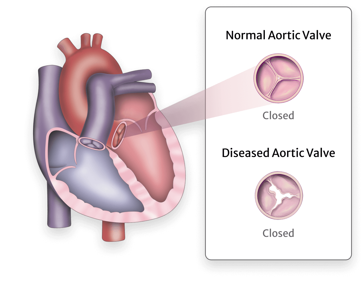 What is aortic regurgitation