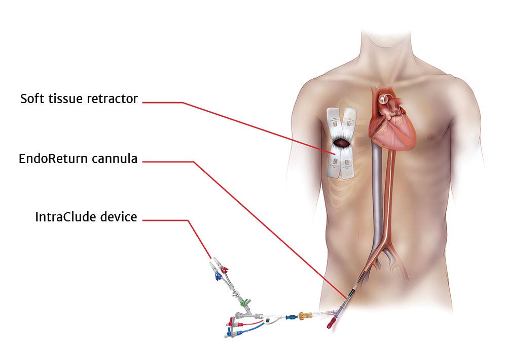 Intraclude endoreturn illustration