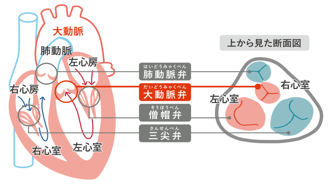 Aortic valve stenosis