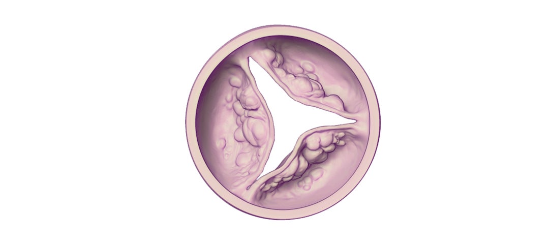 Closed aortic stenosis valve