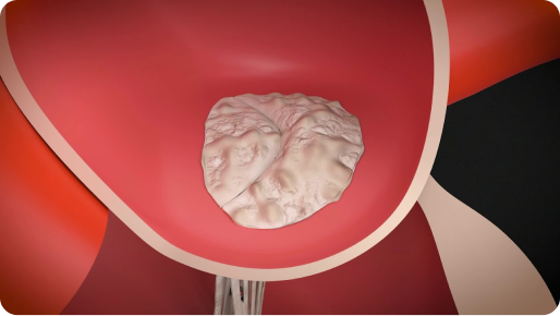 narrowed mitral valve