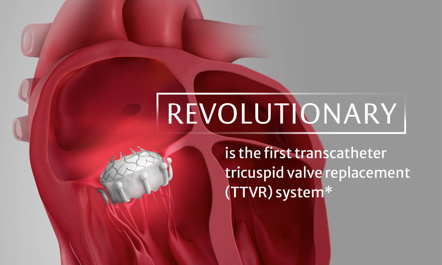 EVOQUE Tricuspid Valve Replacement | Edwards Lifesciences