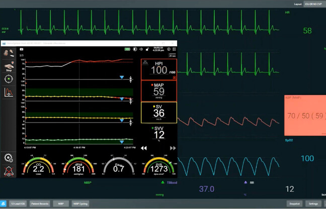 Acumen IQ cuff | Edwards Lifesciences