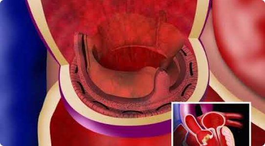 Valve replacement surgery