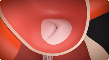 Normal valve movement