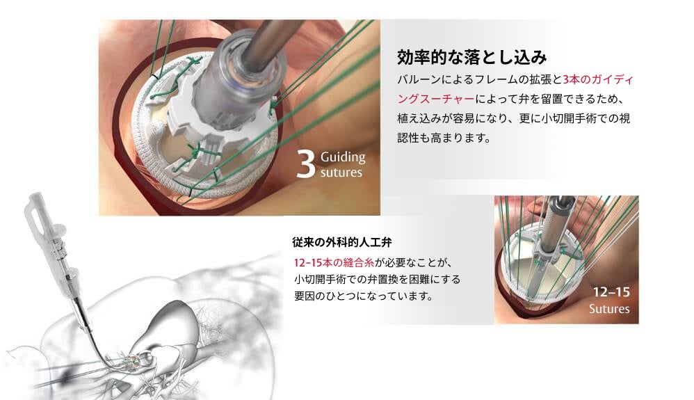EDWARDS INTUITY Elite バルブシステム | Edwards Lifesciences