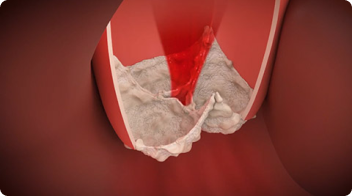Abnormal valve movement
Aortic valve stenosis 
