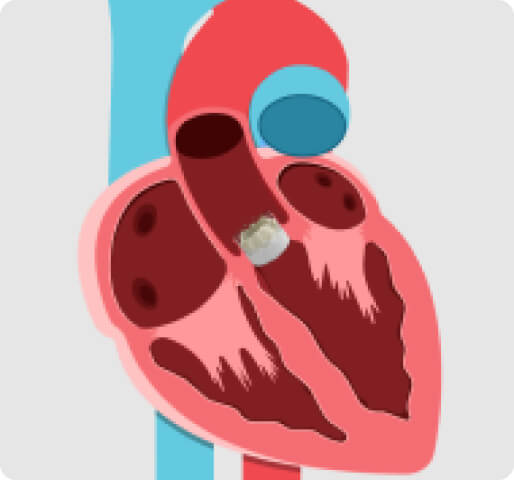 doctor check the new valve and close the incision