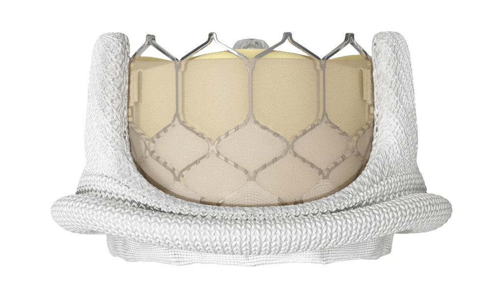 SAPIEN 3 valve in surgical aortic bioprosthetic valve