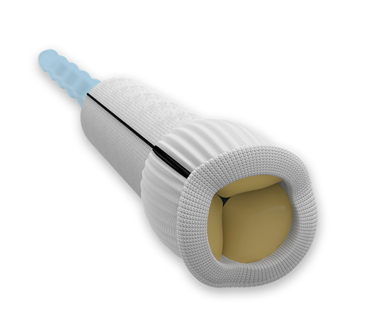 Knoect KONECT RESILIA Aortic Valved Conduit | Edwards Lifesciences