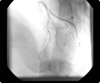 cardiovascular angiography
