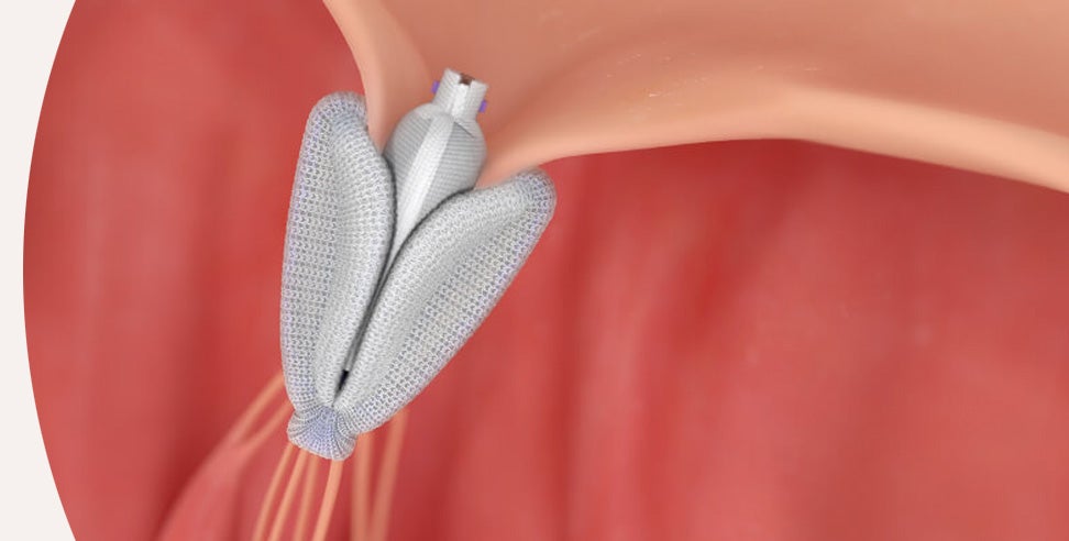 Edwards PASCAL Transcatheter Valve Repair System