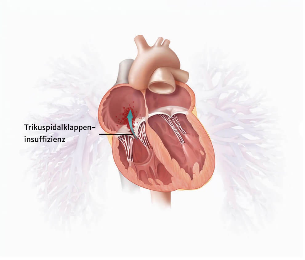 Tricuspid regurgitation