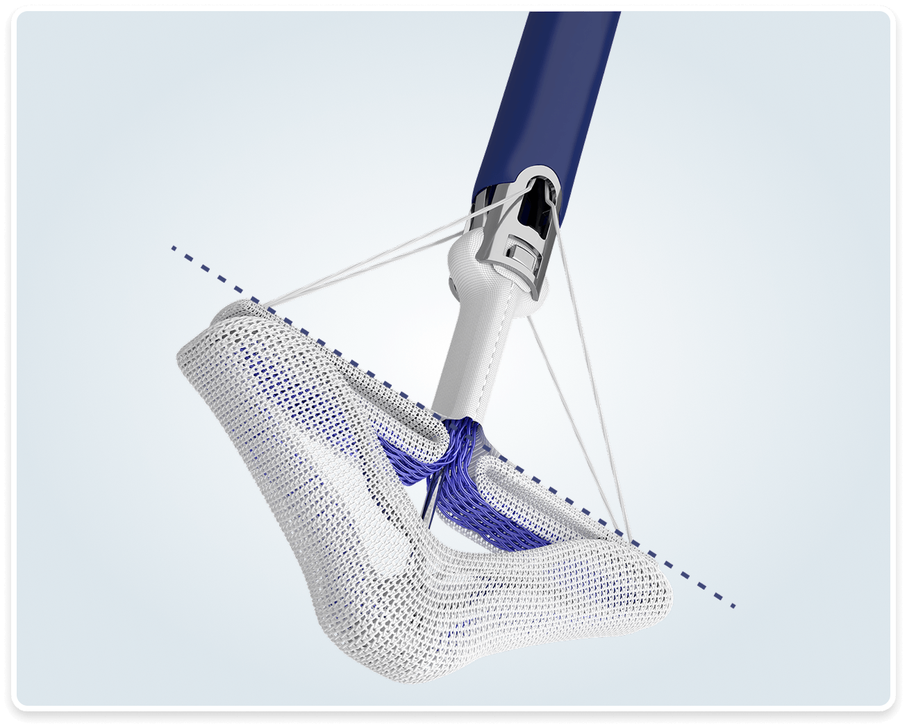PASCAL Precision implant with paddles open, showing its 26 mm wingspan at 180 degrees