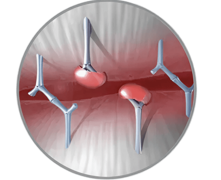 Durability resilia tissue