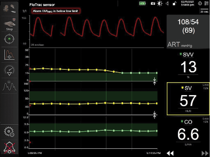 stroke volume variation