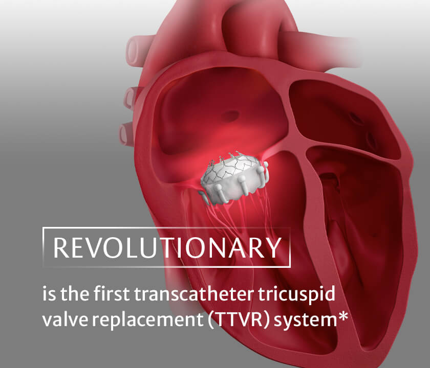 Evoque Tricuspid Valve Replacement Edwards Lifesciences