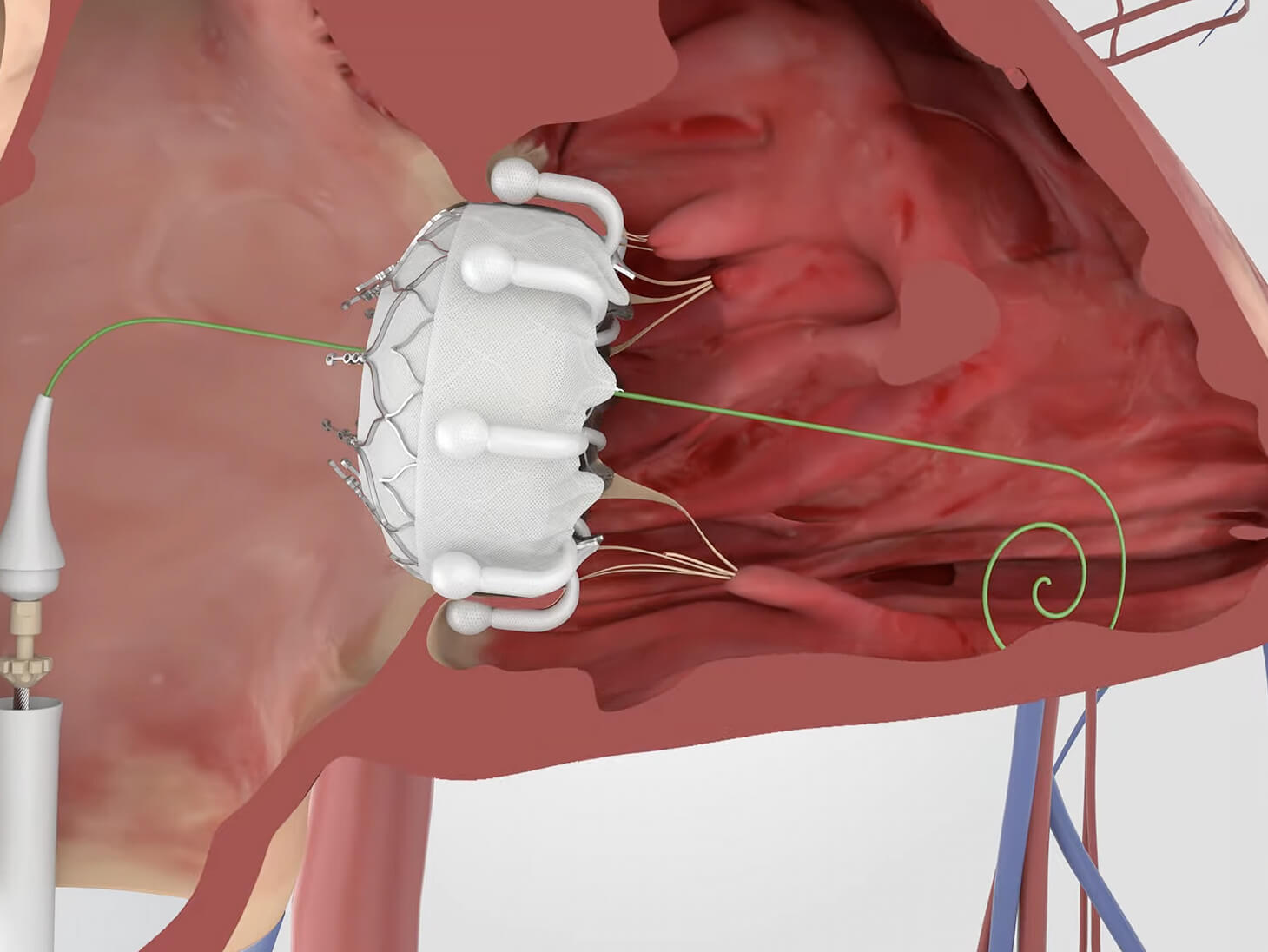 The implant is positioned to fully engage the tricuspid leaflets
