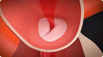 Mitral regurgitation 