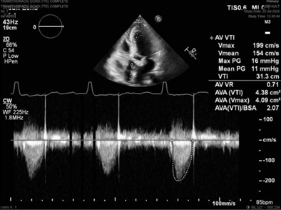 FIGURE 2 Representative predischarge transthoracic echocardiography image with continuous-wave Doppler demonstrating low postoperative aortic valve gradient and velocity in the KONECT RESILIA aortic valved conduit (Edwards Lifesciences, Irvine, CA).