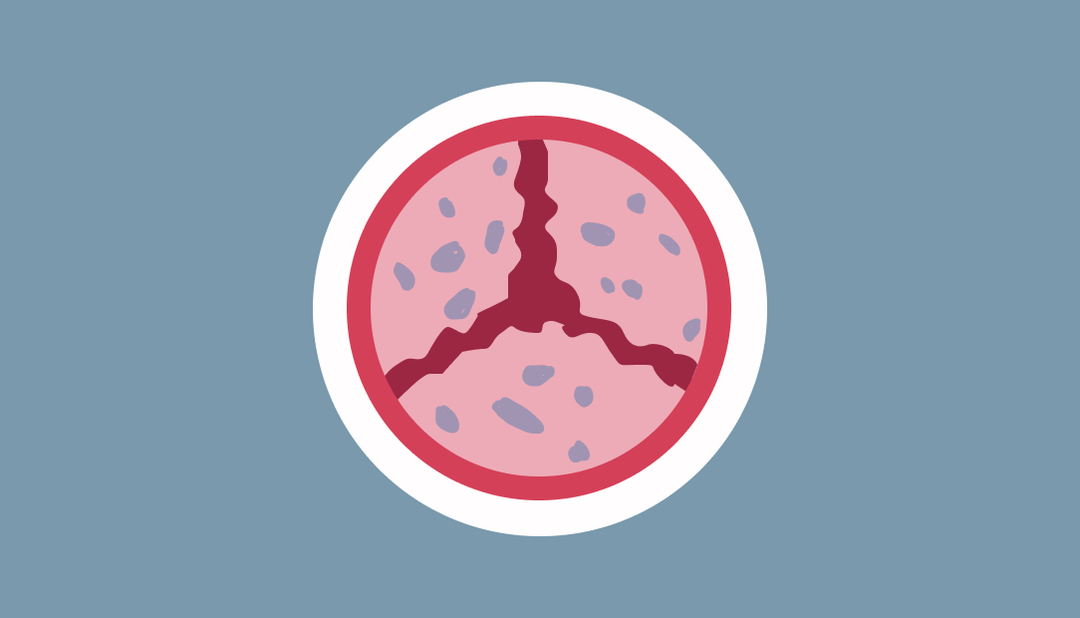What Is Aortic Stenosis Newheartvalve asia what-is-aortic-stenosis-newheartvalve-asia