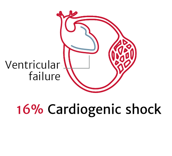 Cardiogenic shock