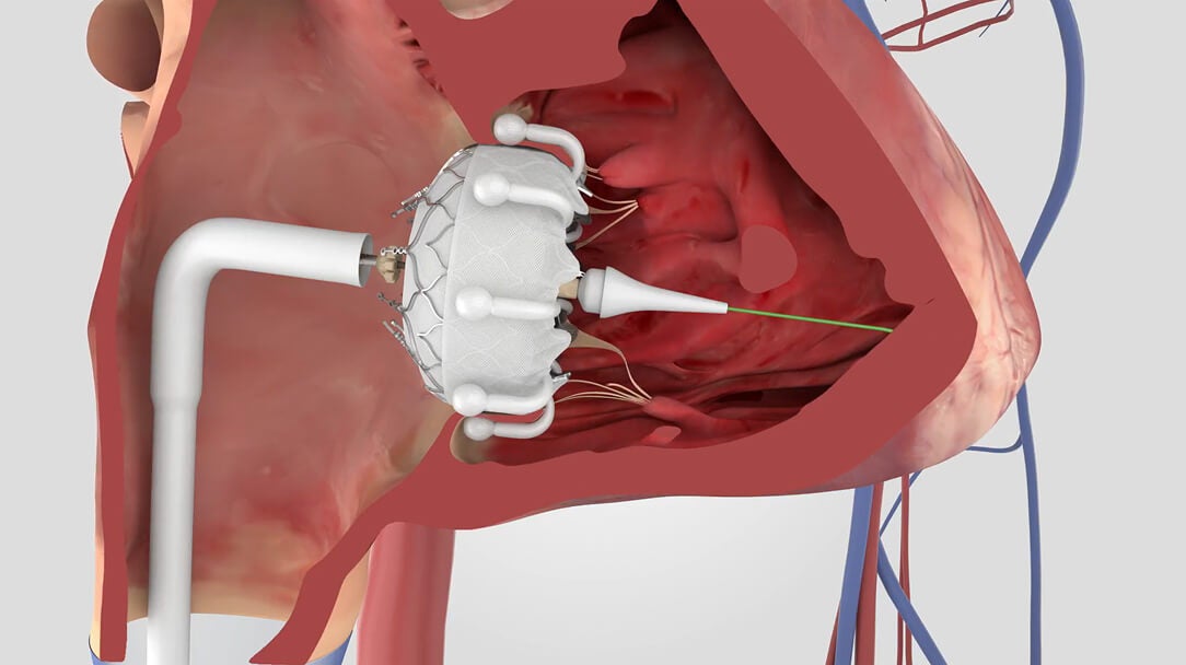 Transcatheter tricuspid valve replacement video thumbnail