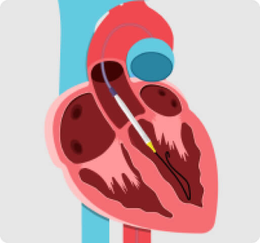  tube with an expandable balloon