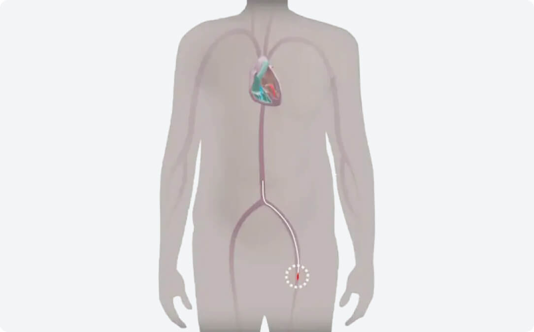 Step 1 TAVI Procedure