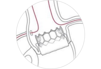 calculated stent structure