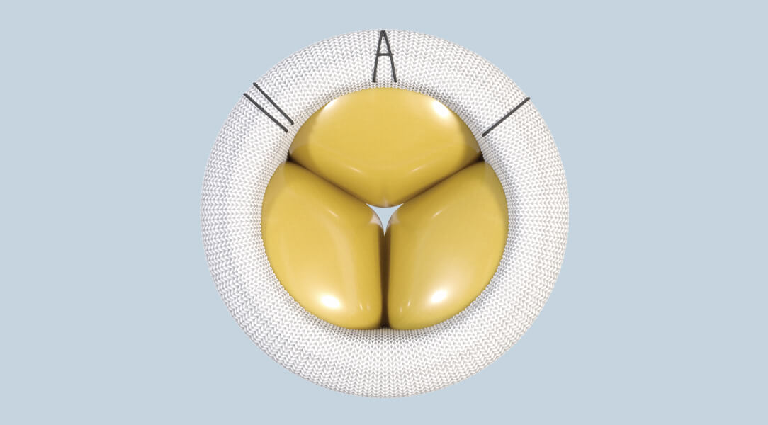 The MITRIS RESILIA mitral valve device preparation
