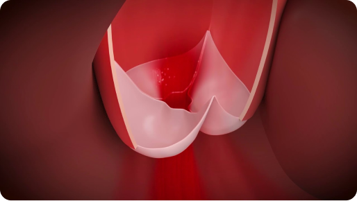 Aortic valve with incompetent regurgitation (regurgitation)