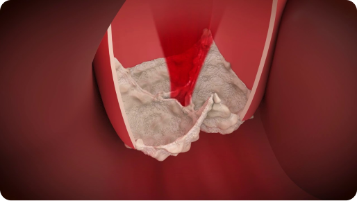 narrowed aortic valve